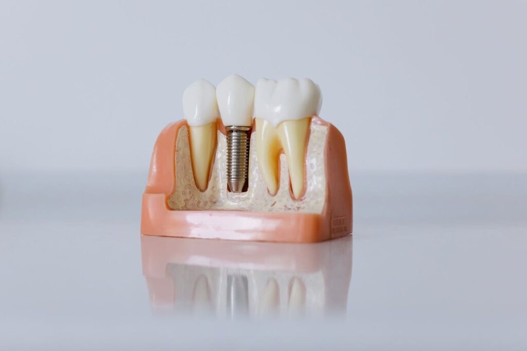 Dental Implants for senior